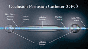 Imagen: El catéter de perfusión oclusión (OPC) Fotografía cortesía de Advanced Catheter Therapies).